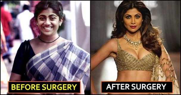 7 Bollywood Actresses Who Underwent Breast Implant Surgery The Youth
