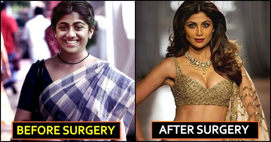 7 Bollywood Actresses Who Underwent Breast Implant Surgery