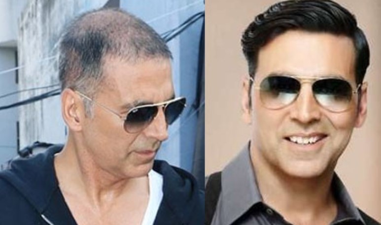 Bollywood celebrities who underwent hair transplant and returned with a bang