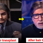 5 Bollywood Celebs Whose Career Changed Drastically After Getting Hair Transplant