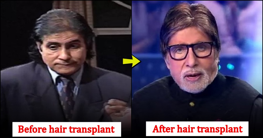 5 Bollywood Celebs Whose Career Changed Drastically After Getting Hair Transplant